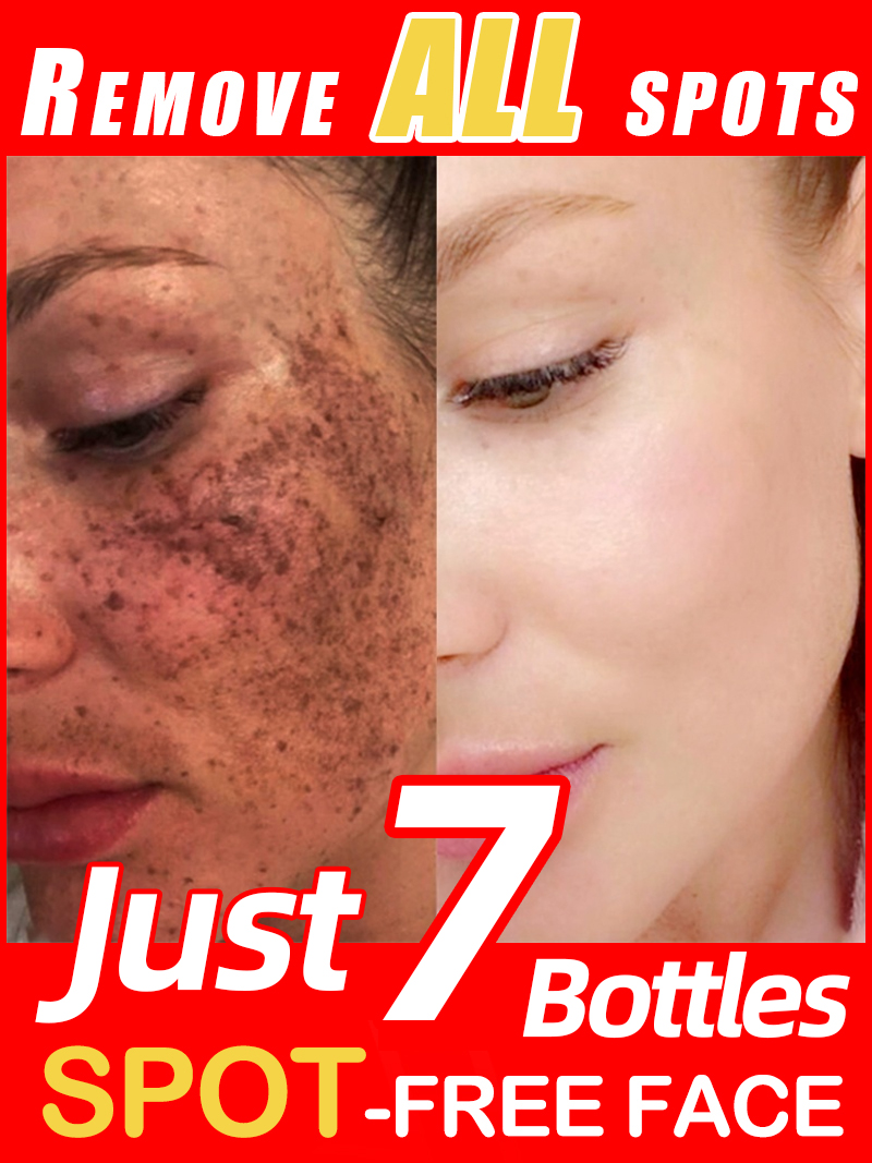 Luxury Skincare Essence - Éclairer les taches de rousseur Melasma,